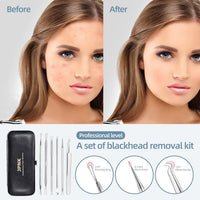 JPNK Blackhead Remover Tool Comedones Extractor Acne Removal Kit for Blemish, Whitehead Popping, 6 Pcs Zit Removing for Nose Face Tools with a Leather Bag